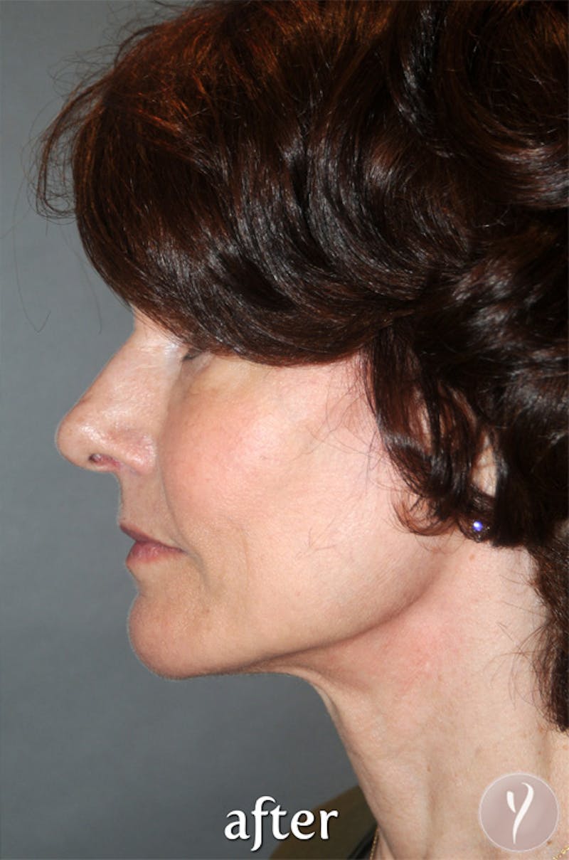 Y LIFT® Before & After Gallery - Patient 279580 - Image 4