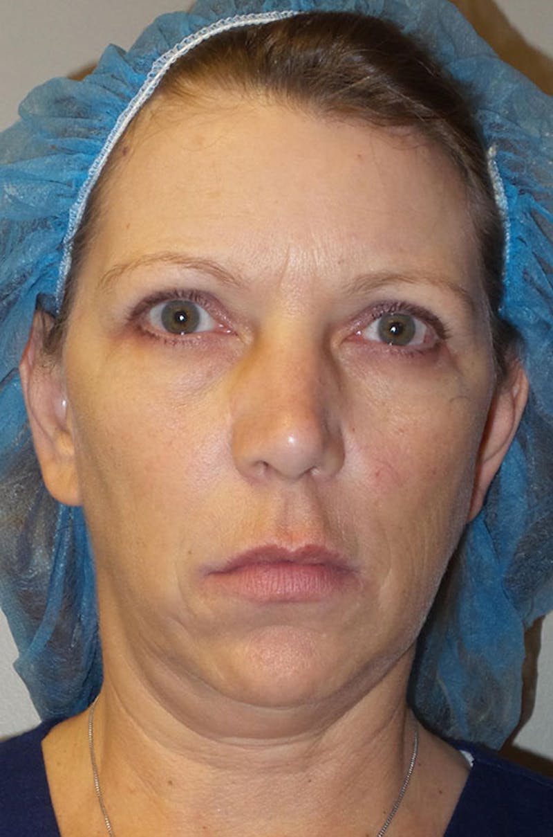 Y LIFT® Before & After Gallery - Patient 247899 - Image 1