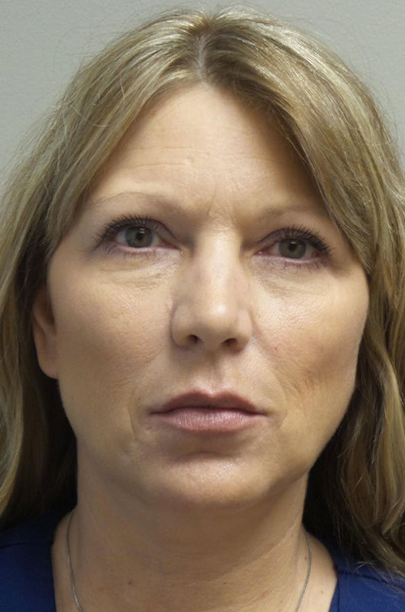 Y LIFT® Before & After Gallery - Patient 247899 - Image 2