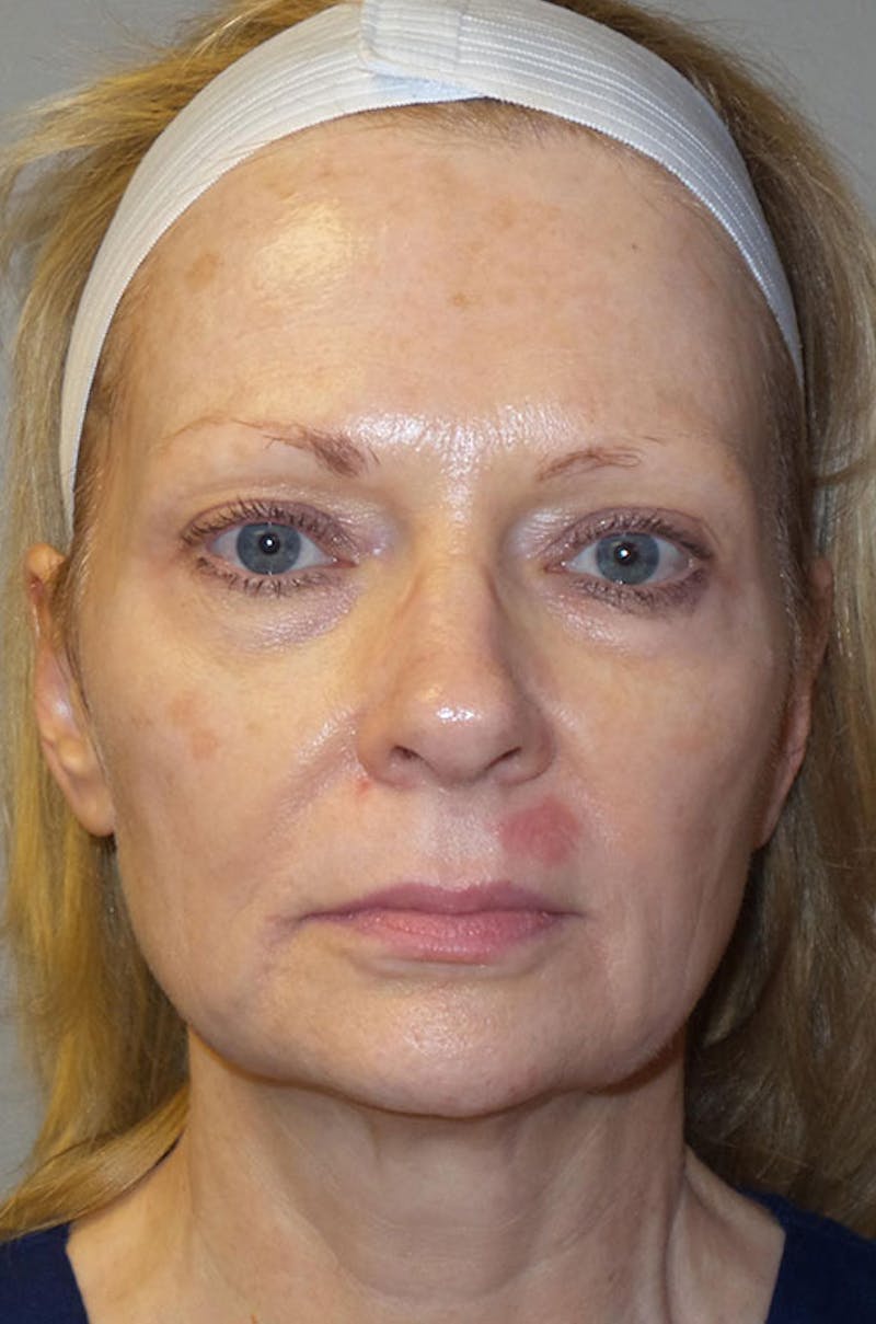 Y LIFT® Before & After Gallery - Patient 130884 - Image 1