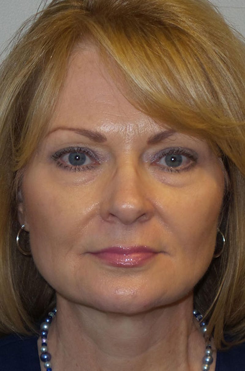 Y LIFT® Before & After Gallery - Patient 130884 - Image 2