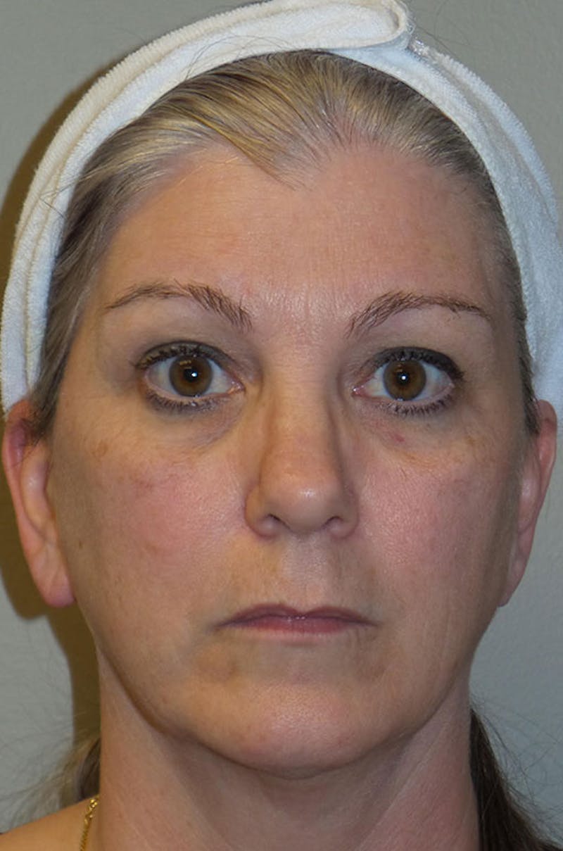 Y LIFT® Before & After Gallery - Patient 171135 - Image 1