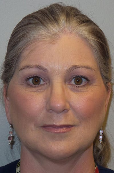 Y LIFT® Before & After Gallery - Patient 171135 - Image 2