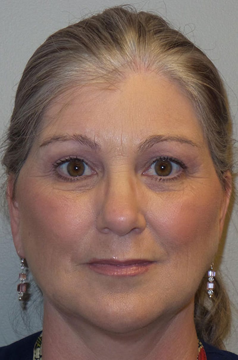 Y LIFT® Before & After Gallery - Patient 171135 - Image 2