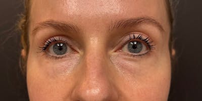 Blepharoplasty Before & After Gallery - Patient 258827 - Image 2