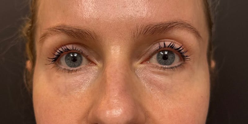 Blepharoplasty Before & After Gallery - Patient 258827 - Image 2