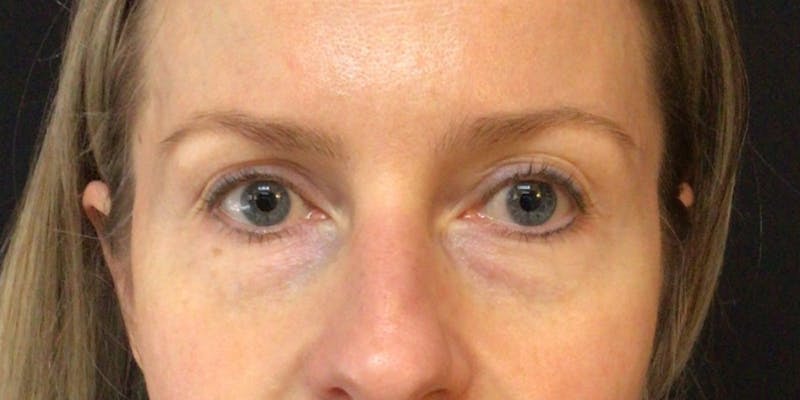 Blepharoplasty Before & After Gallery - Patient 258827 - Image 1