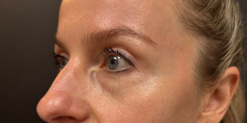 Blepharoplasty Before & After Gallery - Patient 258827 - Image 4