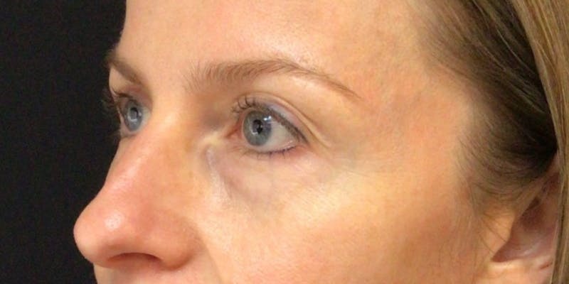 Blepharoplasty Before & After Gallery - Patient 258827 - Image 3