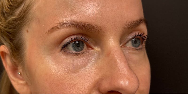 Blepharoplasty Before & After Gallery - Patient 258827 - Image 6