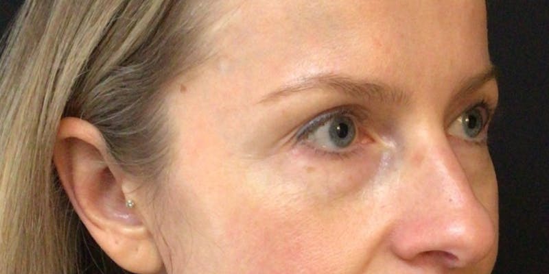Blepharoplasty Before & After Gallery - Patient 258827 - Image 5