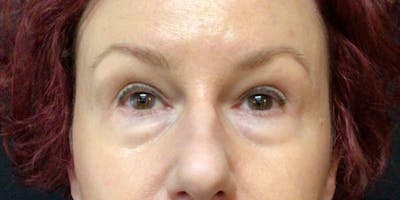 Blepharoplasty Before & After Gallery - Patient 401621 - Image 1