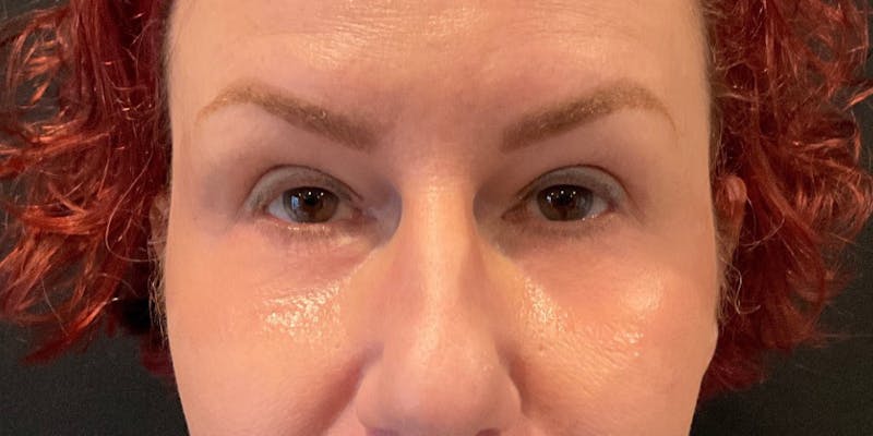 Blepharoplasty Before & After Gallery - Patient 401621 - Image 2