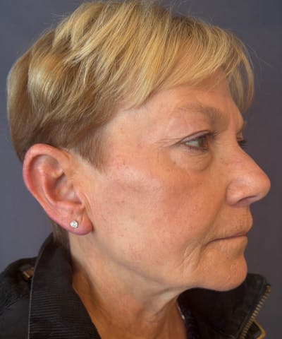 RHA Fillers Before & After Gallery - Patient 360217 - Image 2
