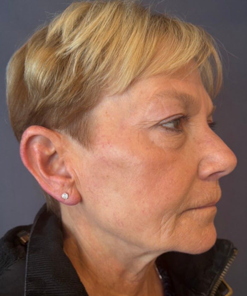 RHA Fillers Before & After Gallery - Patient 360217 - Image 2