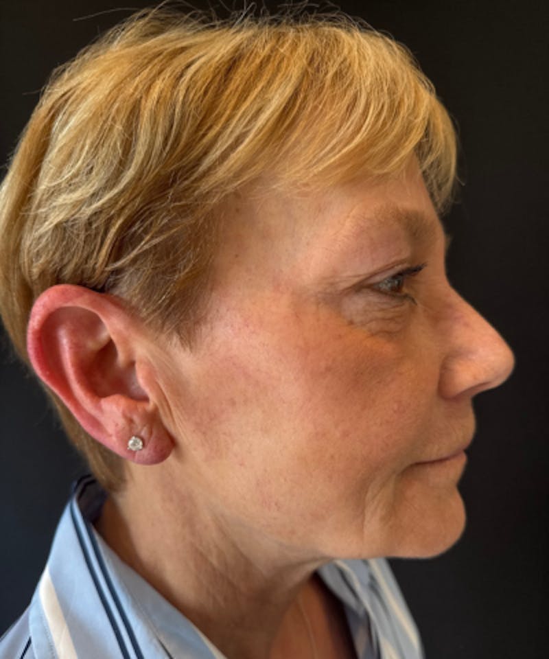 RHA Fillers Before & After Gallery - Patient 360217 - Image 1