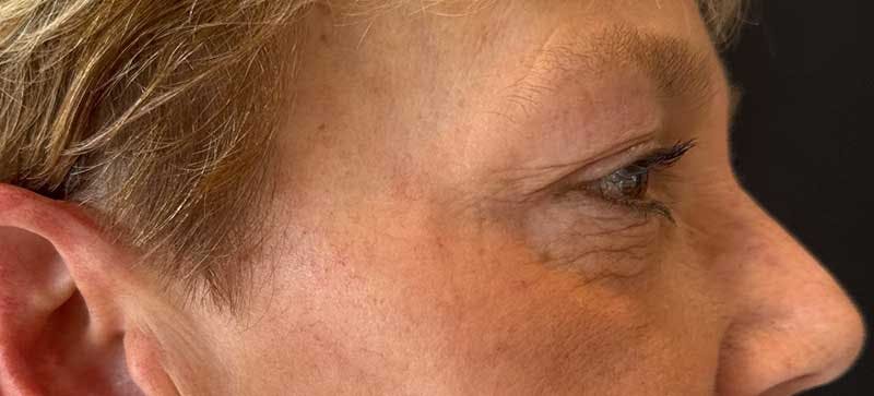 BOTOX Before & After Gallery - Patient 106263 - Image 1