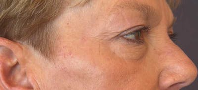 BOTOX Before & After Gallery - Patient 106263 - Image 2