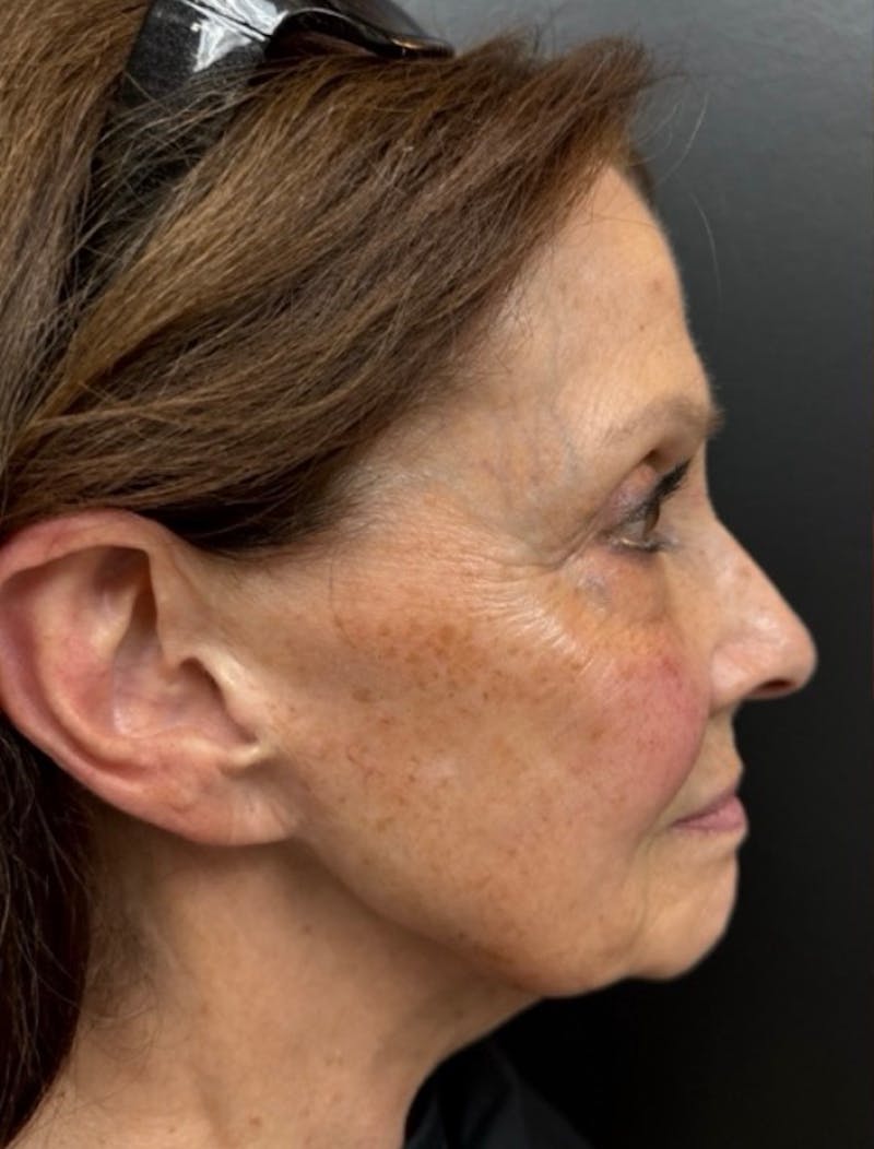 BBL Hero Before & After Gallery - Patient 225430 - Image 1