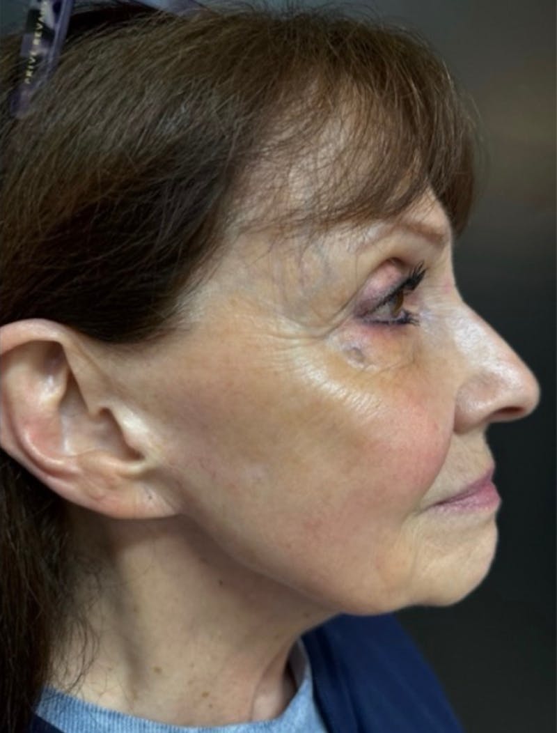 BBL Hero Before & After Gallery - Patient 225430 - Image 2