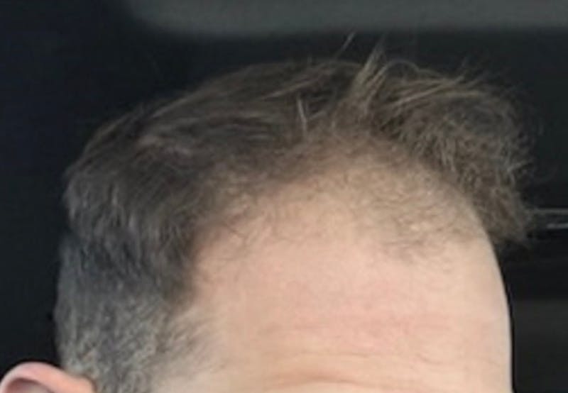 NeoGraft For Men Before & After Gallery - Patient 353040 - Image 1