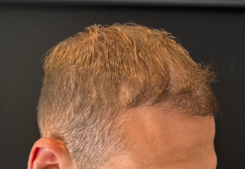 NeoGraft For Men Before & After Gallery - Patient 353040 - Image 2