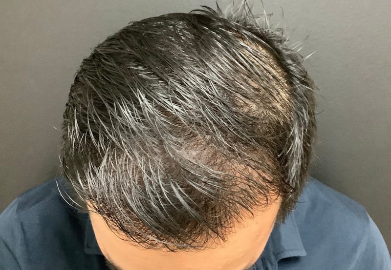 NeoGraft For Men Before & After Gallery - Patient 138333 - Image 2