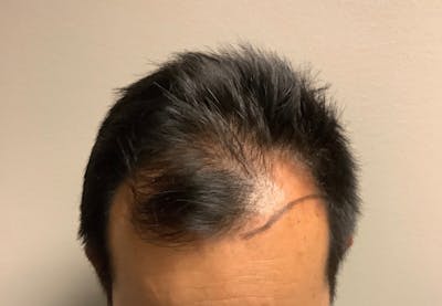 NeoGraft For Men Before & After Gallery - Patient 138333 - Image 1