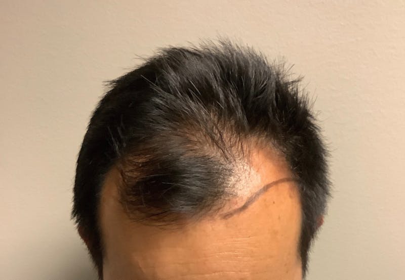 NeoGraft For Men Before & After Gallery - Patient 138333 - Image 1