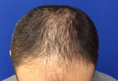 NeoGraft For Men Before & After Gallery - Patient 421045 - Image 1