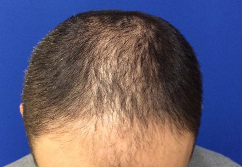 NeoGraft For Men Before & After Gallery - Patient 421045 - Image 1