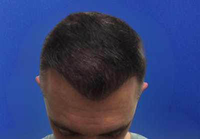 NeoGraft For Men Before & After Gallery - Patient 421045 - Image 2