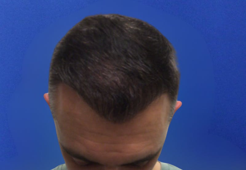 NeoGraft For Men Before & After Gallery - Patient 421045 - Image 2