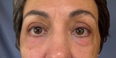 Blepharoplasty Before & After Gallery - Patient 212191 - Image 1