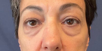 Blepharoplasty Before & After Gallery - Patient 212191 - Image 2