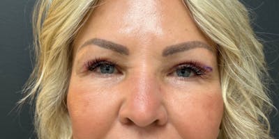 Blepharoplasty Before & After Gallery - Patient 344113 - Image 2