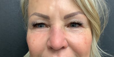 Blepharoplasty Before & After Gallery - Patient 344113 - Image 1