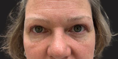 Blepharoplasty Before & After Gallery - Patient 210825 - Image 2