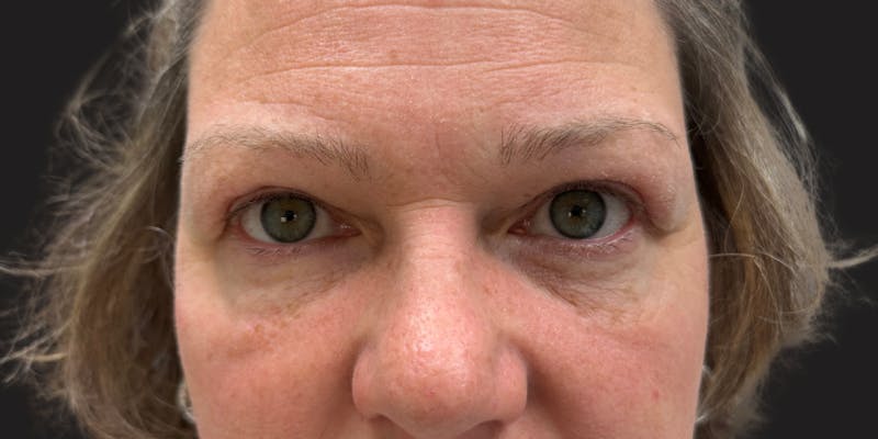 Blepharoplasty Before & After Gallery - Patient 210825 - Image 2