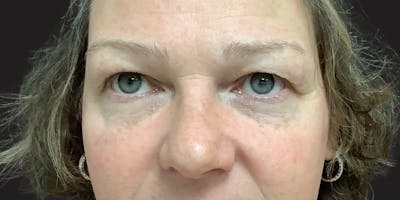 Blepharoplasty Before & After Gallery - Patient 210825 - Image 1