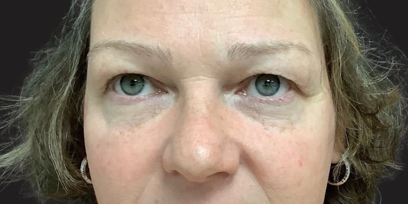 Blepharoplasty Before & After Gallery - Patient 210825 - Image 1