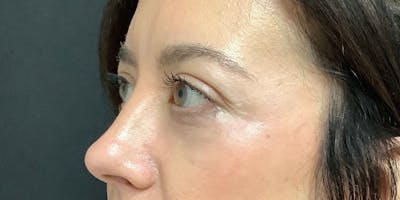 Blepharoplasty Before & After Gallery - Patient 170019 - Image 2