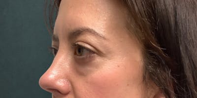 Blepharoplasty Before & After Gallery - Patient 170019 - Image 1