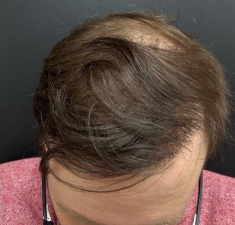 NeoGraft For Men Before & After Gallery - Patient 252043 - Image 2