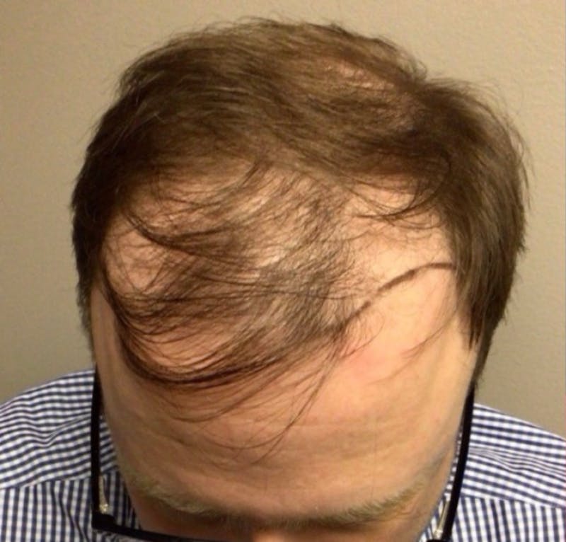 NeoGraft For Men Before & After Gallery - Patient 252043 - Image 1