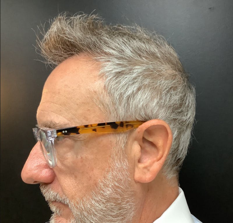 NeoGraft For Men Before & After Gallery - Patient 374267 - Image 2