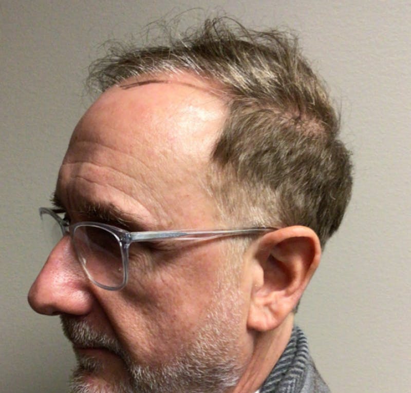 NeoGraft For Men Before & After Gallery - Patient 374267 - Image 1