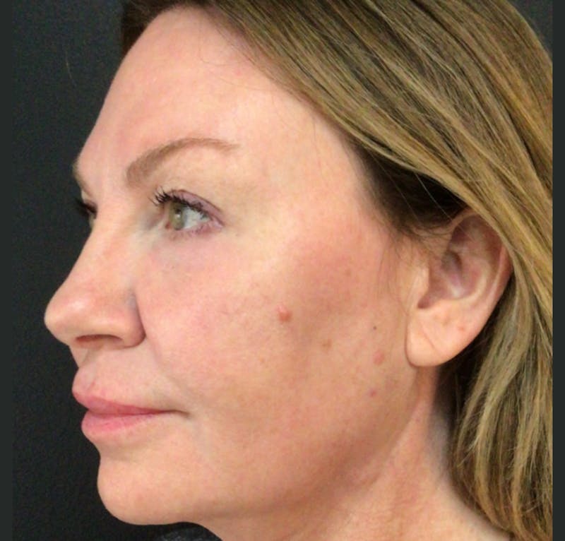 Laser Resurfacing Before & After Gallery - Patient 268320 - Image 2