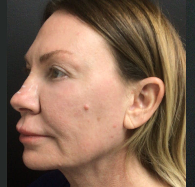 Laser Resurfacing Before & After Gallery - Patient 268320 - Image 1