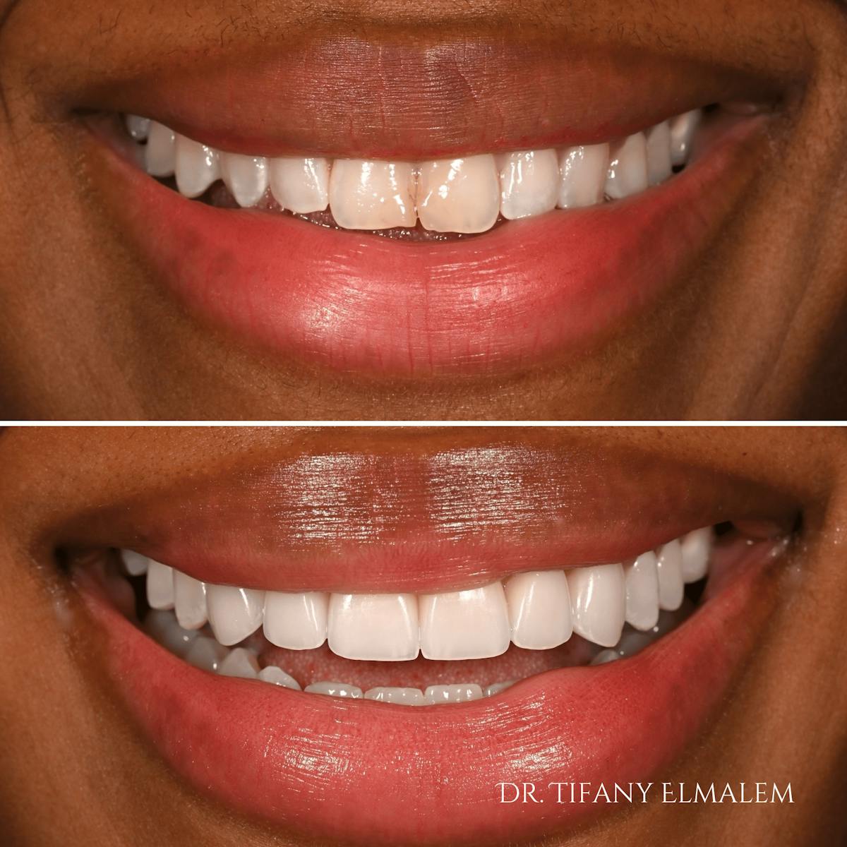 Cosmetic Services Gallery Before & After Gallery - Patient 232279 - Image 1